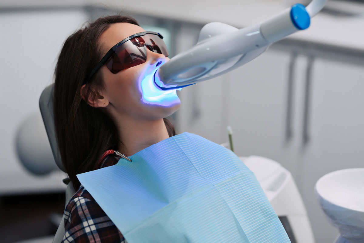 Sbiancamento dentale con laser