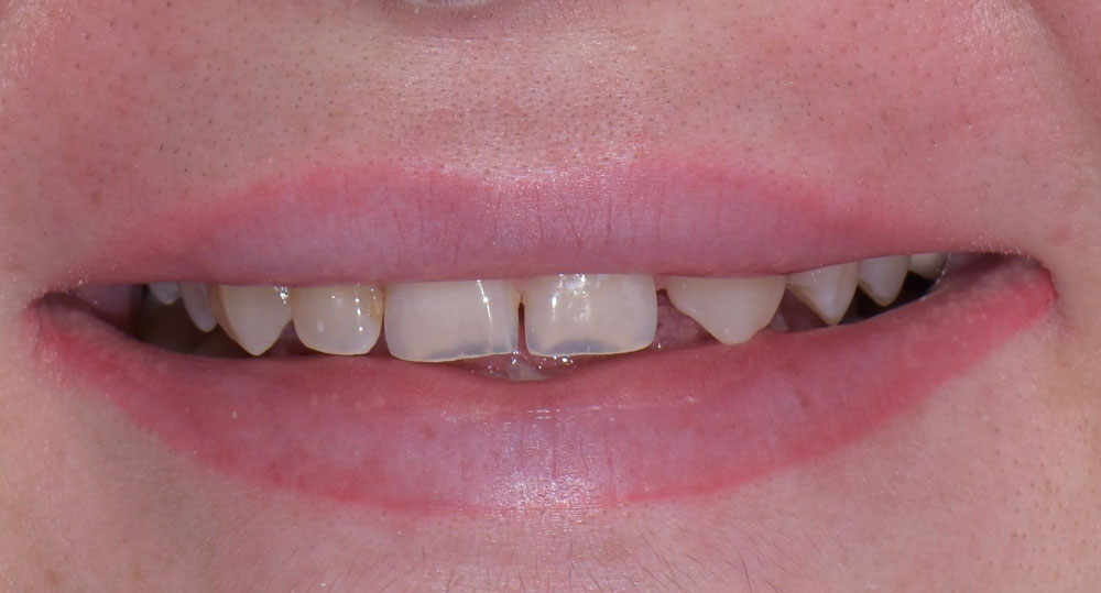 Faccette Dentali