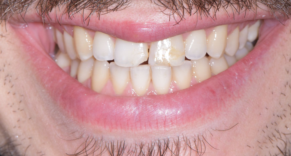 Faccette Dentali