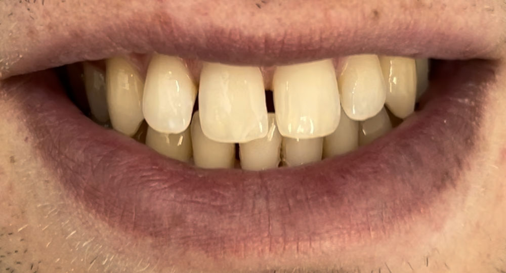 Faccette Dentali