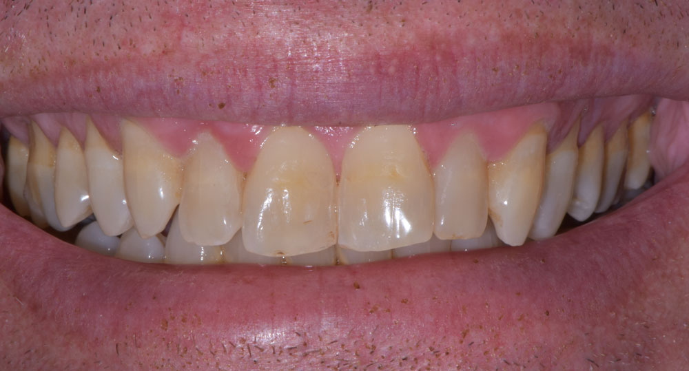 Faccette Dentali