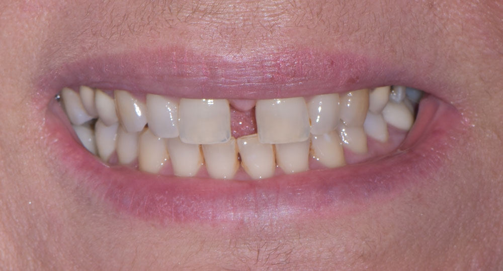 Faccette Dentali