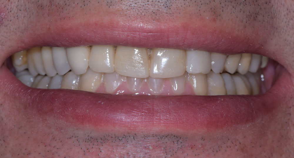Faccette Dentali