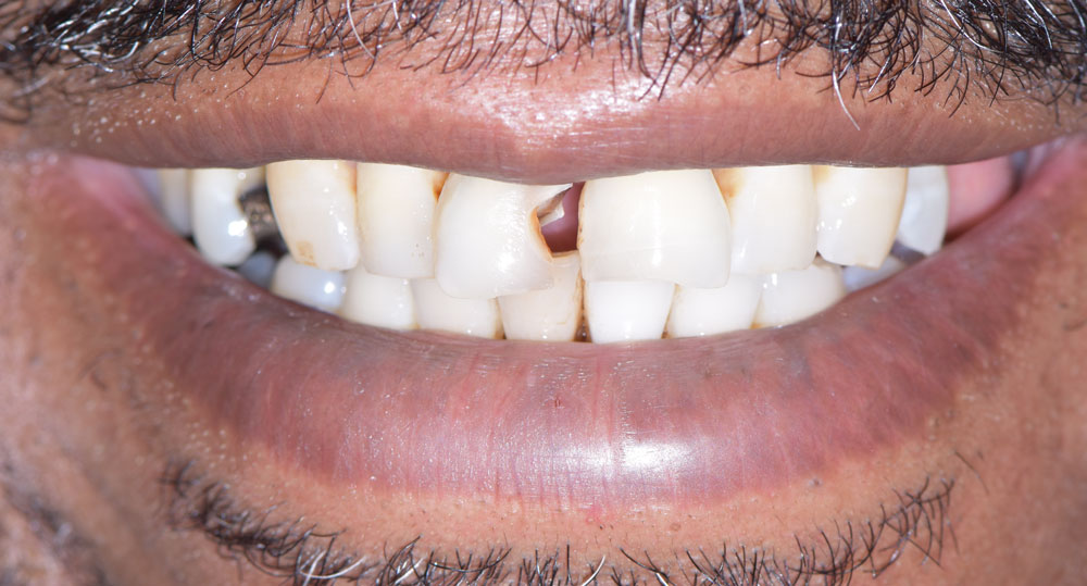 Faccette Dentali