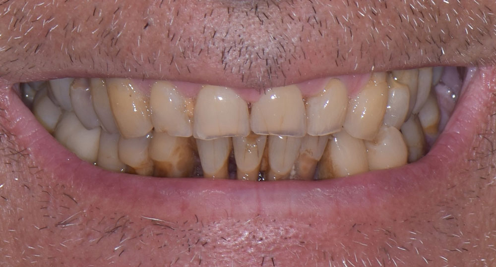 Faccette Dentali